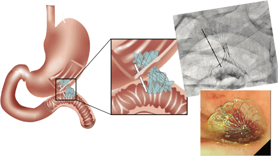 EUS-GJ-STEMS EUS-GJ-STEMS